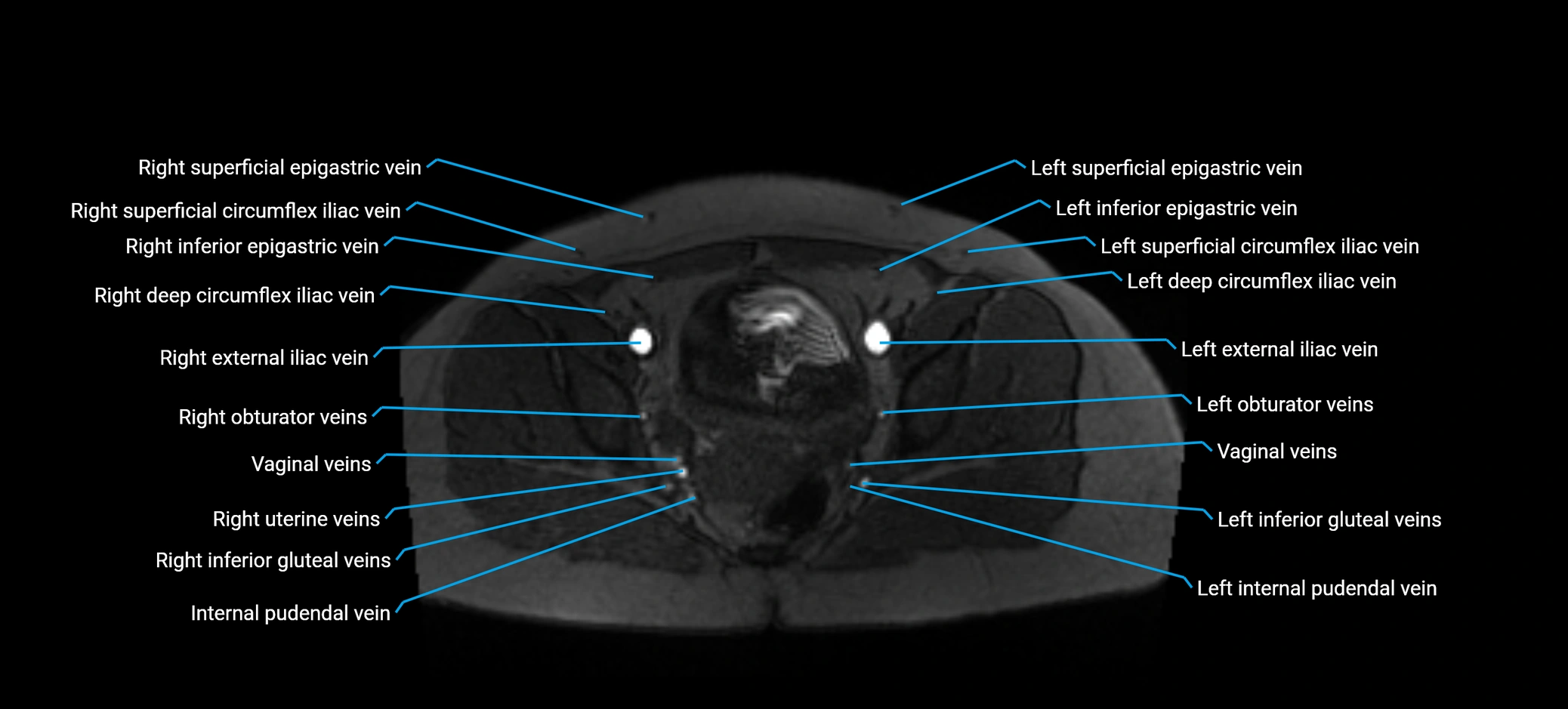 MRV abdomen pelvis & lower limb axial cross sectional anatomy labelled MRI image 167 (1).webp